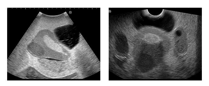 Ultraschall der weiblichen Beckenanatomie