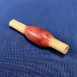 3D Med Aufgabeneinsatz für Eileiterschwangerschaft