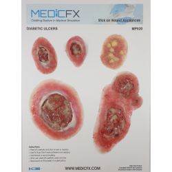 MedicFX – Set Wundmodelle „Diabetes Ulcus“