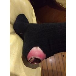 MedicFX – Wundmodell „Fersendekubitus“