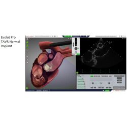 HeartWorks Modul 14 –  optionales Upgrade TAVI 