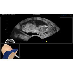 ScanTrainer „TVS-Examine - Modul 11 – Transvaginal-Ultraschall-Training- Fortgeschrittene” – für ScanTrainer Standard