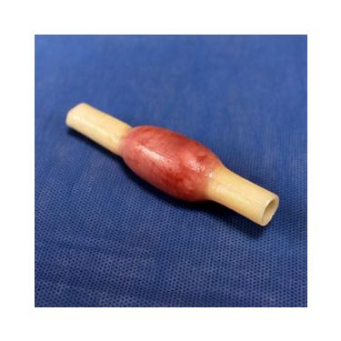 3D Med Aufgabeneinsatz für Eileiterschwangerschaft