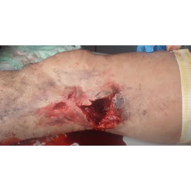 MedicFX – Bein für Wound-Packing und Tourniquet-Einsatz