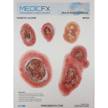 MedicFX – Set Wundmodelle „Diabetes Ulcus“
