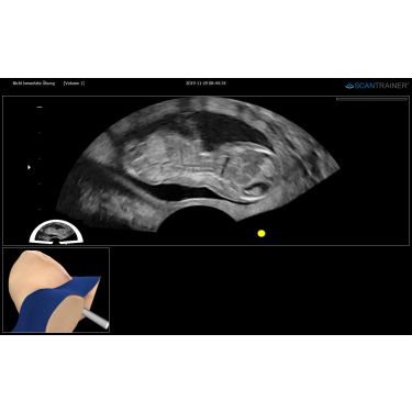 ScanTrainer „TVS-Examine - Modul 11 – Transvaginal-Ultraschall-Training- Fortgeschrittene” – für ScanTrainer Standard